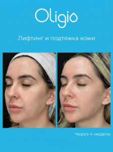 result-oligio-01