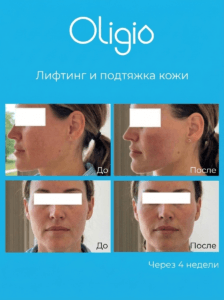 result-oligio-02