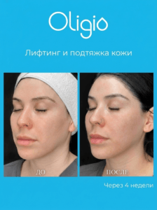 result-oligio-03